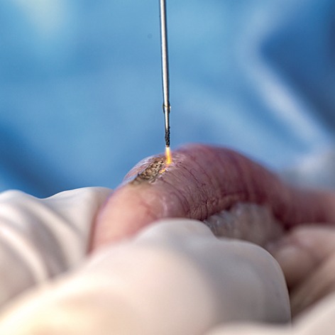 DISCOVER AIRPLASMA<sup>®</sup> TECHNOLOGY<br>Performance in plastic surgery